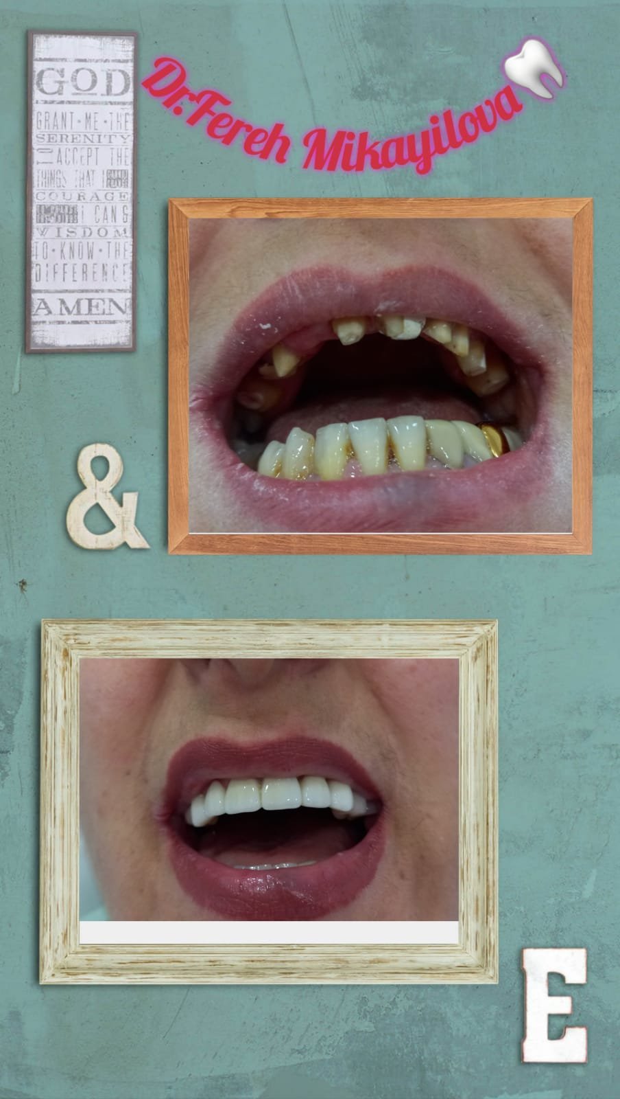Hollywood Smile - Dental clinicin təcrübəli həkim-stomatoloqu Fərəh Mikayılova -, vinirlər yalnız sağlam dişlərin səthinə tətbiq olunur